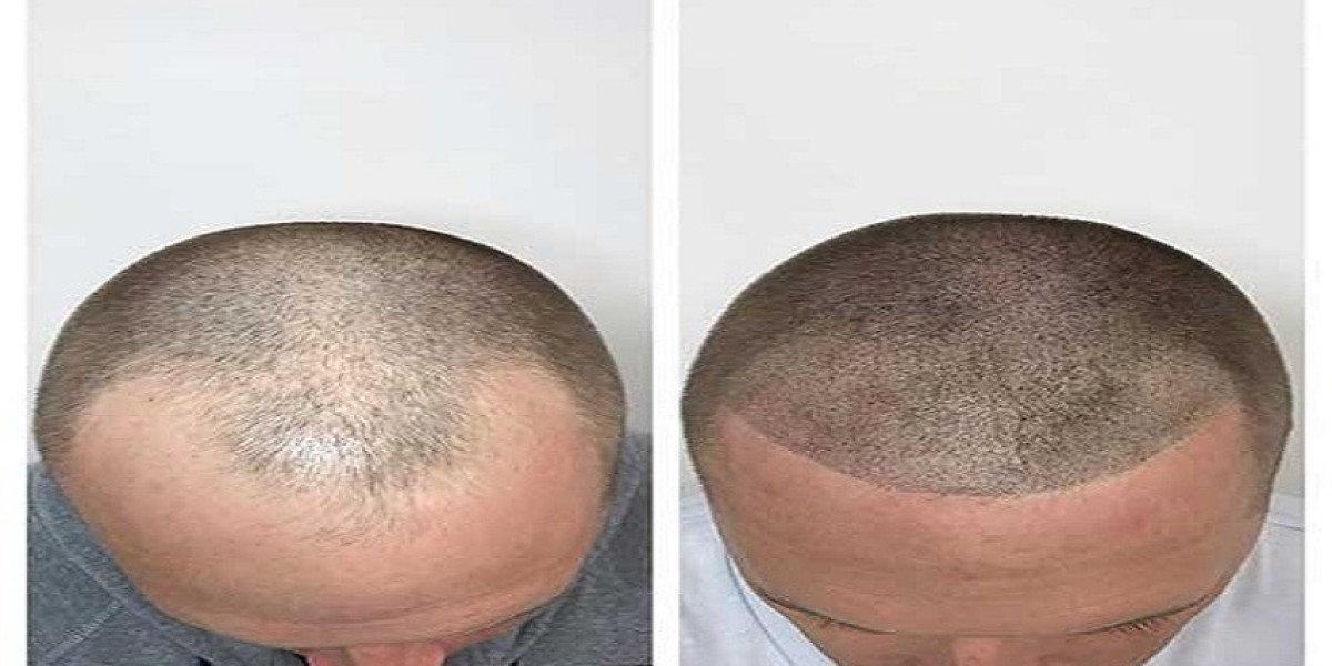 When Is the Right Time to Start Low Level Laser Hair Therapy for Hair Loss?